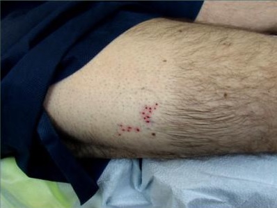 Arm Hair | BHT Grafts| Initial Testing Arm Hair | BHT Grafts| Initial Testing