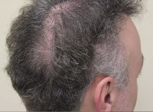 Photo of Patient Before His BHT Hair Repair Surgery