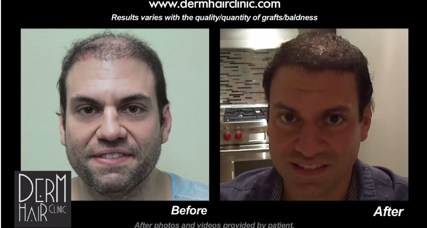 Front View of Beard Hair Transplant Results