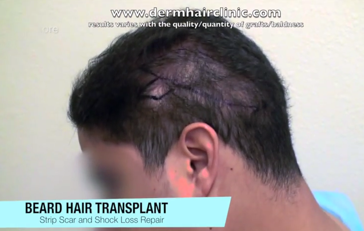 Repair of shock loss after an old strip surgery hair transplant by follicular unit extraction by Dr U