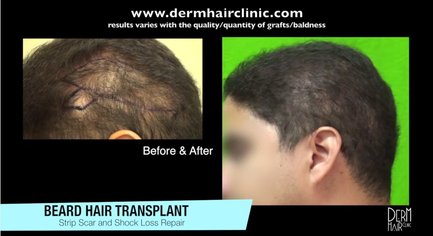 Before and After Beard Hair Transplant For Shock Loss