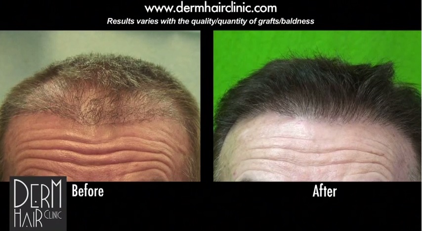 FUE Hair Transplant 2850 UGrafts Repairs And Restores