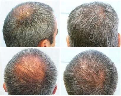 Balding Crown Restored Using Beard hair