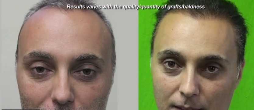  FUE Hair Transplant With Beard Hair Grafts - Before and after 6000 Grafts