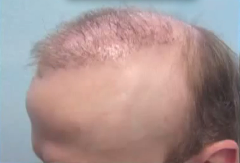 Extreme Hair Transplant Repair Case - Before Body Hair Grafts