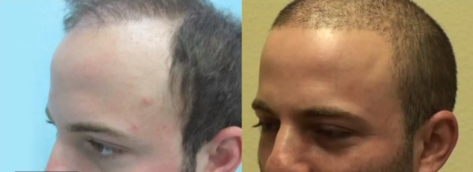 Beard Hair Transplant|Best Coverage