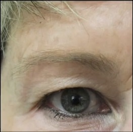 Patient's Sparse Brows Before Surgery