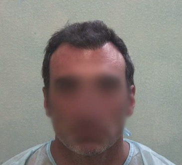 Patient Before His FUE Hair Transplant Surgery