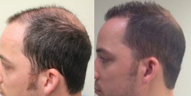 Patient Before and After Advanced FUE