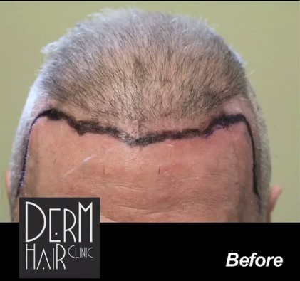 Patient Before His Beard Hair Transplant Surgery