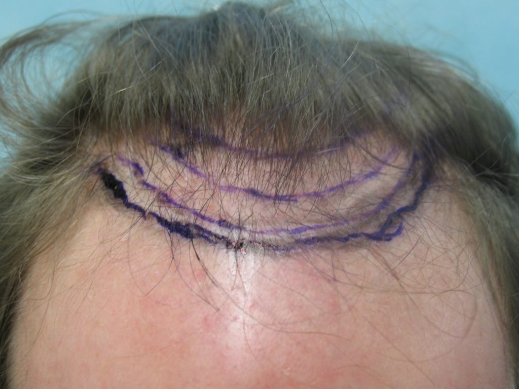 Dr U Patient desiring a conservative very soft undetectable hairline - Photo before Dr Umar surgery