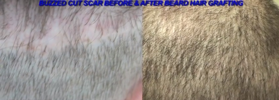 Strip Scar Repair | Body Hair Grafts
