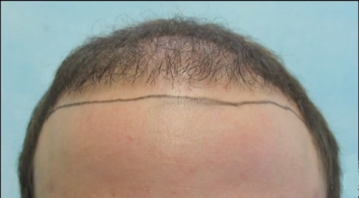 Patient With Receded Hairline Before BHT Repair Surgery