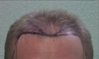 Photo of FUE Hair Transplant Patient Before Surgery