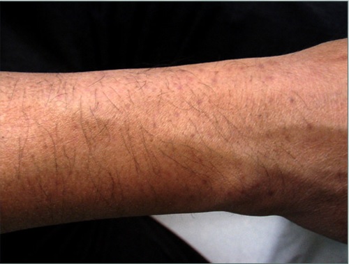 Wound Healing Variations After Body Hair Transplantation Donor Area Pigmentation