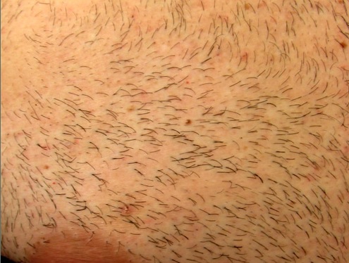 Advantages of body hair transplant| Chest Donor Region| Wound Healing