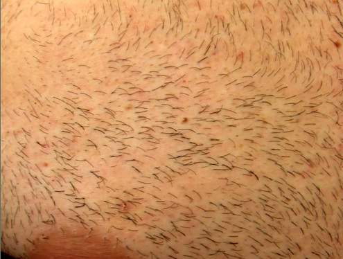 Body Hair Transplant| Chest Donor Region| Wound Healing