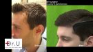 Fore head size reduction by DrUGraft FUE Hair Transplant