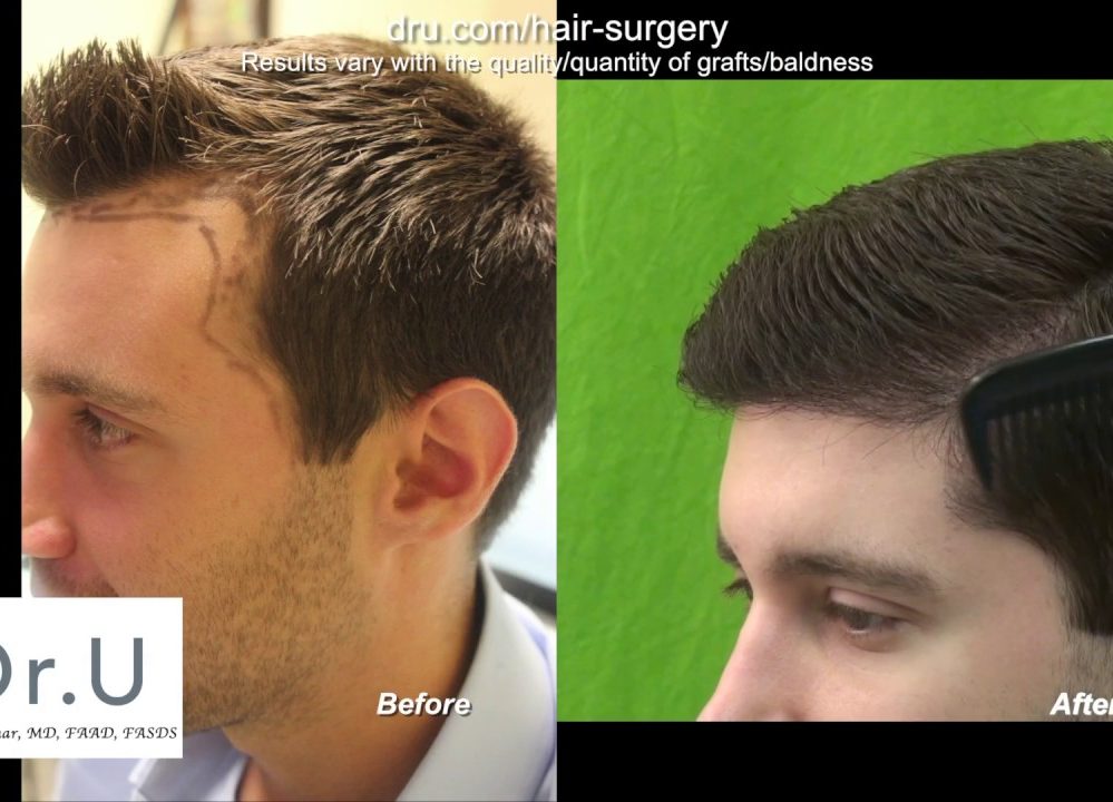 DrUGraft FUE Hairline Restoration Reduces Forehead Size DermHair Clinic