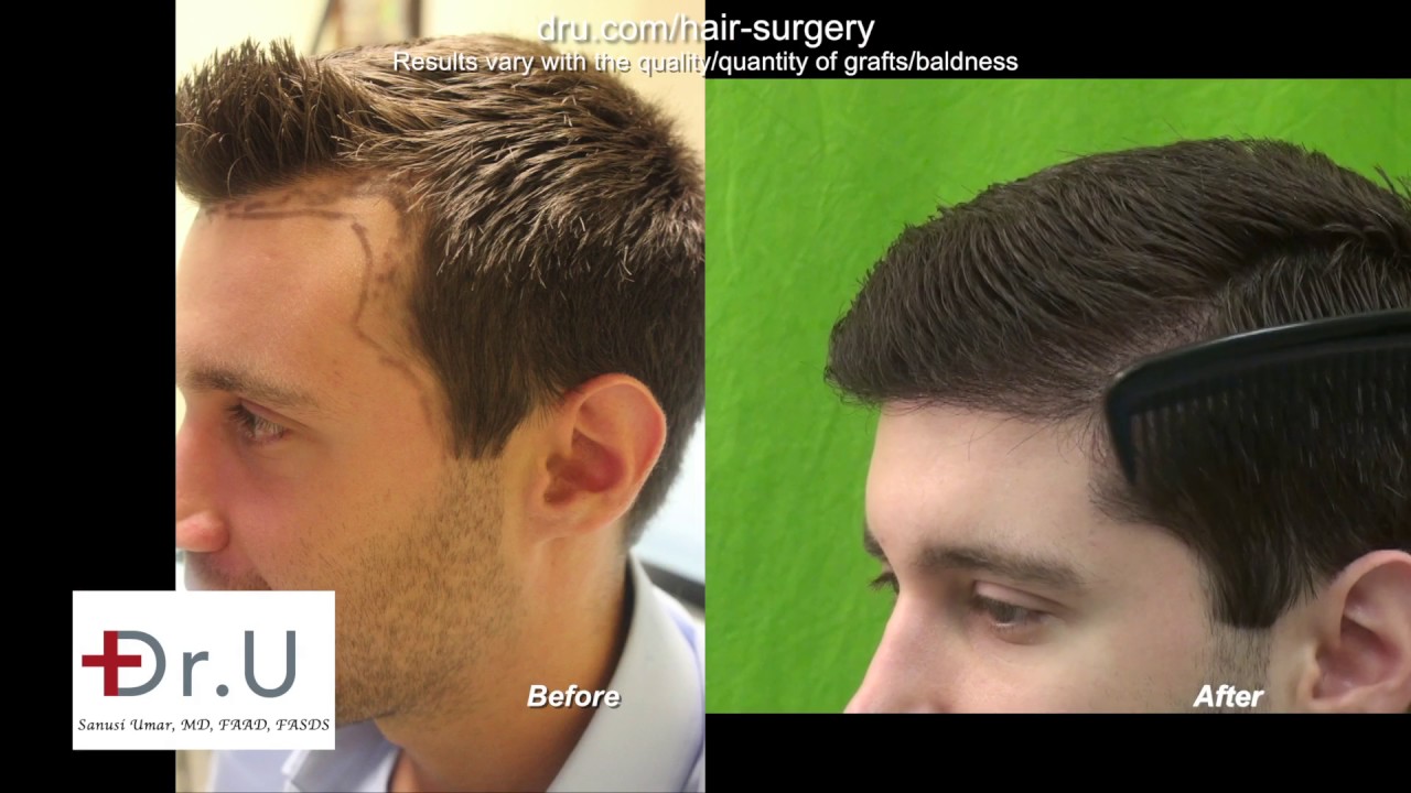 Before & After Posts Featuring Norwood 2-3 Hair Loss Patients