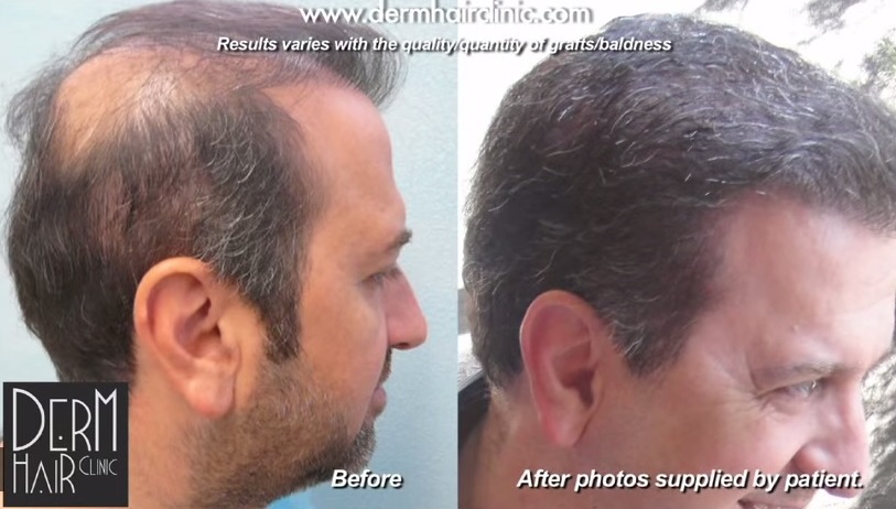 Side View of Body Hair Transplant Results -14000 Grafts