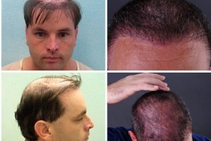 Hair Restoration Testimonials by G.Dowles