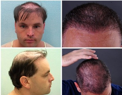 Body Hair Transplant Photos|Before & After Images