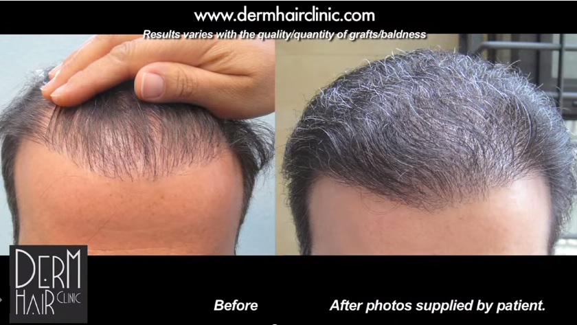 before and after Hairline Restoration Using Body Hair Transplant - chest hair was used by Dr U