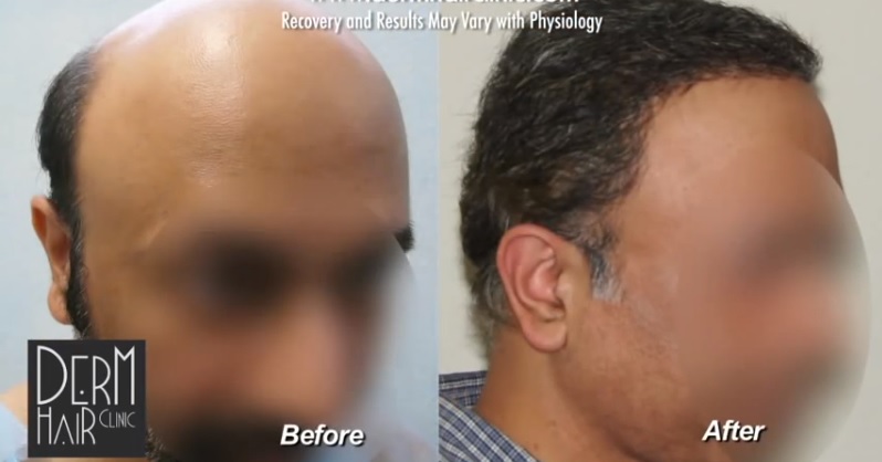 Result Gallery of the Best Hair Transplant Doctor would feature cases that would seem impossible to achieve