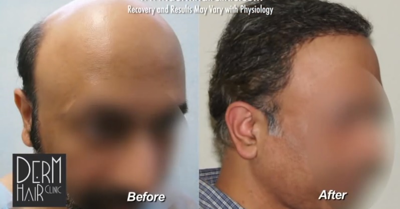 Beard Hair Reverses Severe Norwood 7 Baldness