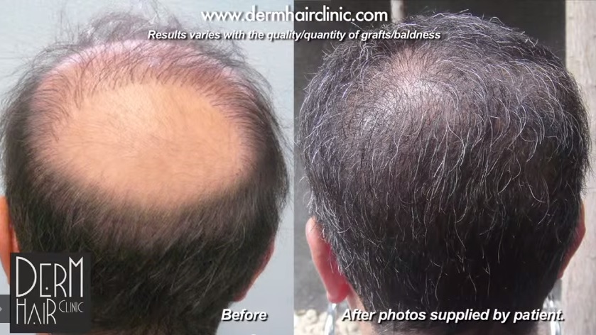 Impossible Hair Transplant Repair - 14000 BHT Grafts