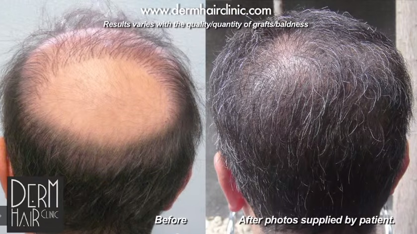 Hair transplant mistakes of poor donor planning and graft placement in crown corrected by Dr U's Ugraft advanced FUE and body hair transplant