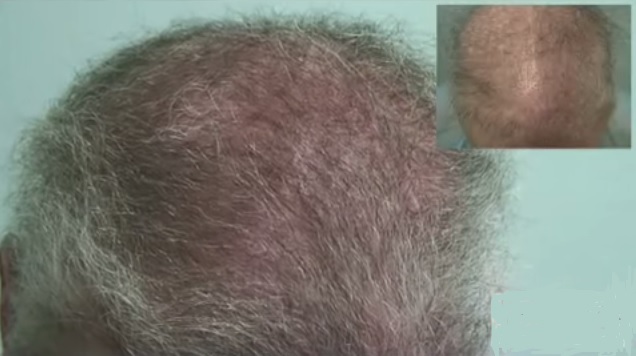 Body Hair Follicles Offer New Hope For Severe Repair Case