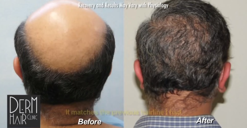 Baldness Completely Transformed By Hair Transplant Surgery