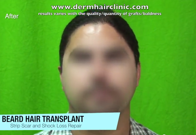 Front View Of Beard Hair Transplant Results