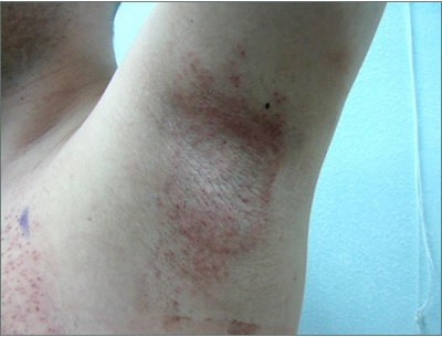 Body Hair Transplant| Donor Region| Left Armpit Body Hair Transplant| Donor Region| Left Armpit