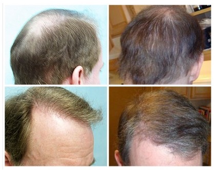 Hair Transplant Results on FUE Patient