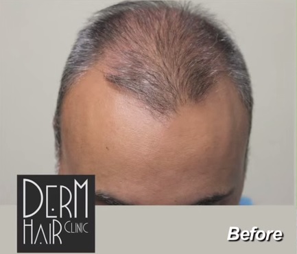 Patient Before His Body Hair Transplant For Strip Scar and Global Coverage
