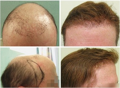 best FUE hair transplant surgeon| Patient's results|before and after