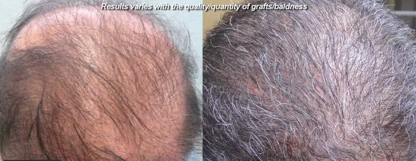 Low growth. Repair of Weird Growth After Patient's First Hair Transplant