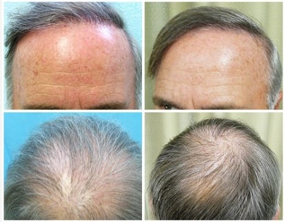 Grey Hair - Can It Be Reversed? A Case Report