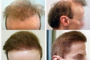 The Worst Hair Transplant Repair Patient Testimonial by Anonymous Before and after Dr U repair