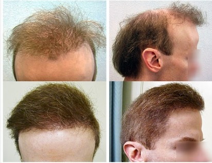 Body Hair Transplantation Versatility