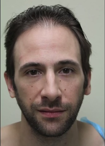 Celebrity Bernardo de Paula Before His Hair Transplant Surgery