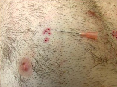 Body Hair Transplant Testing – Basic Principles Sample Extractions Body Hair Transplant Testing – Basic Principles Sample Extractions