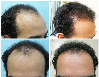 Conservative Hairline Restoration With FUE