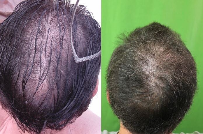 How Does a Crown Hair Transplant Work  Elithair