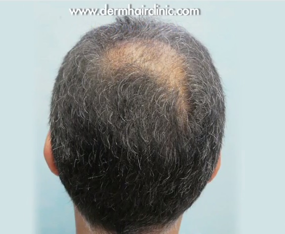 Patient Before His Crown Hair Restoration Surgery