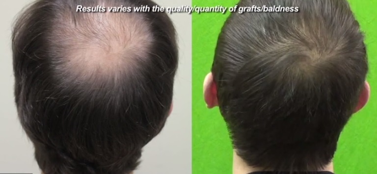 Follicular Unit Strip Surgery Hair Graft Versus FUE Hair Grafts