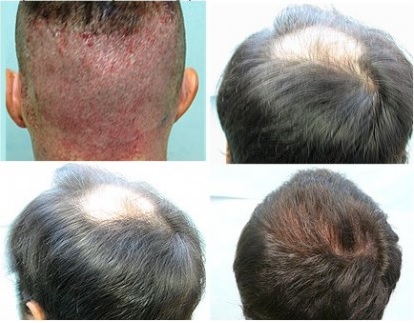 Graft Count affected bu the extent of hair loss. Mild loss in a UGraft patient before and after 1500 grafts